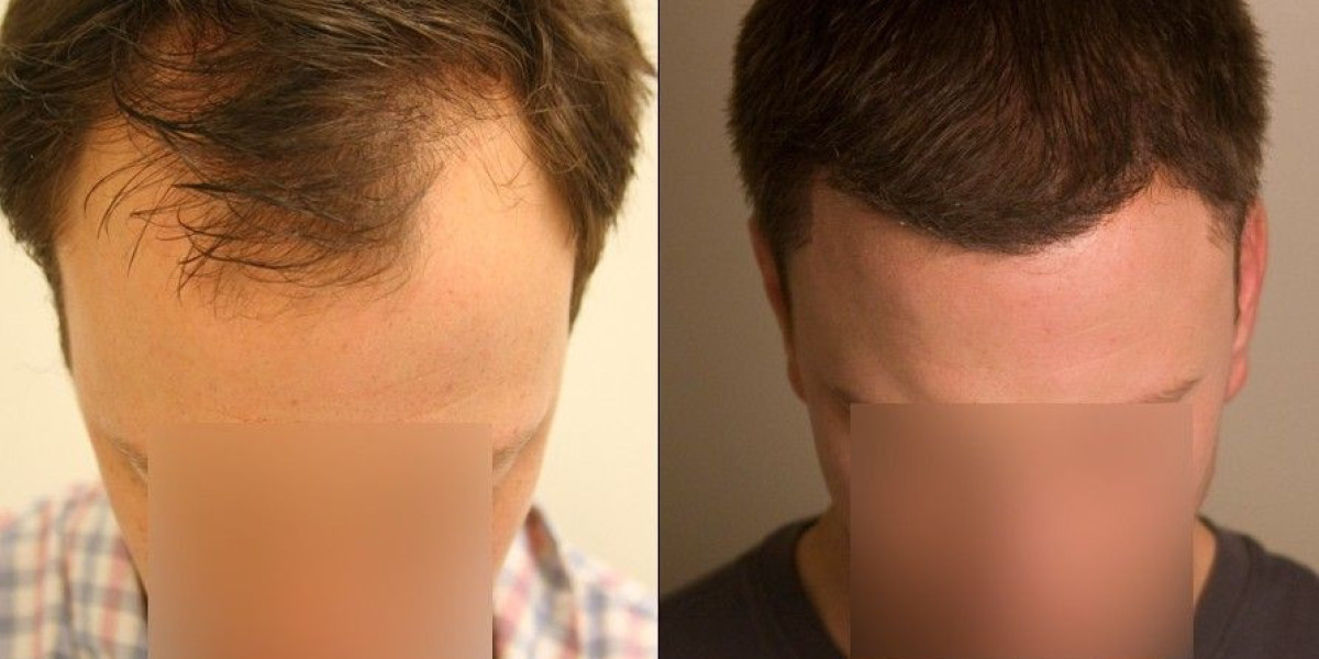 Hair Restoration Market Growth: Key Drivers, Technologies, and Projected Trends for 2025-2030