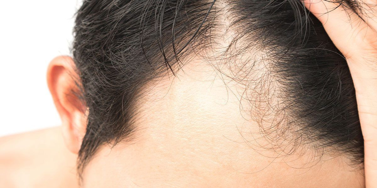 Alopecia Treatment Market Analysis, Size, Share, Growth, Trends, and Forecasts by 2031