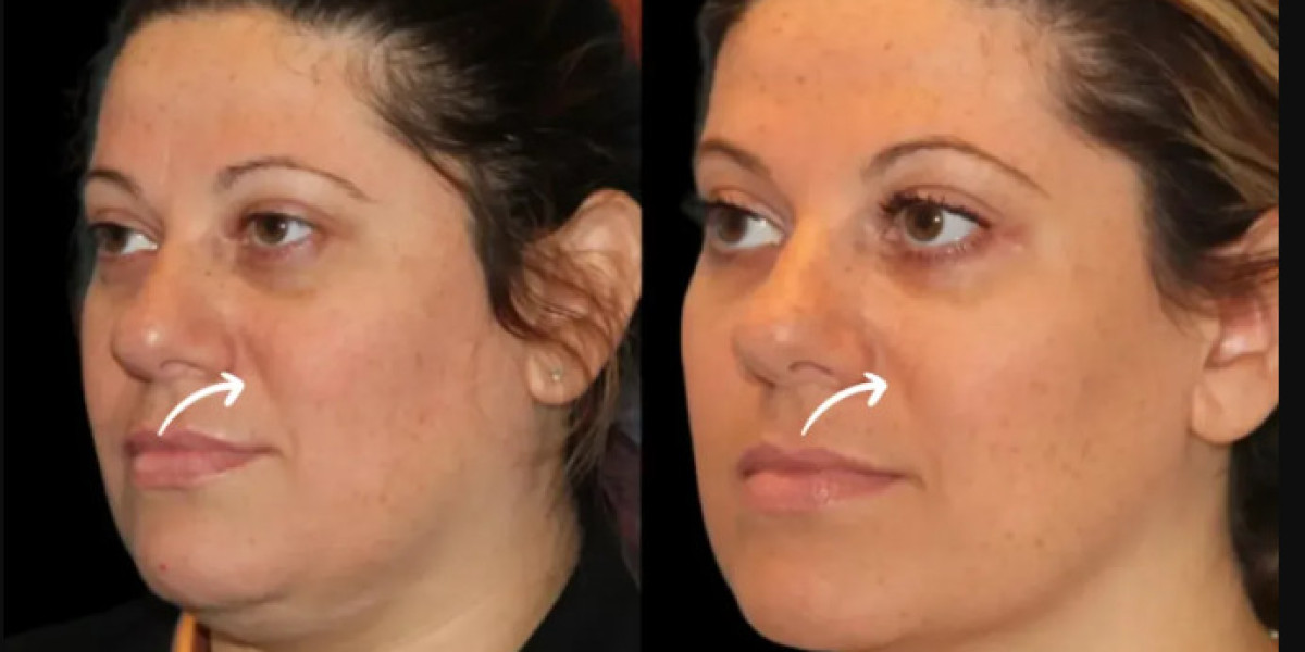 Sculptra Fillers in Dubai for Buttocks Augmentation: A Non-Surgical Alternative