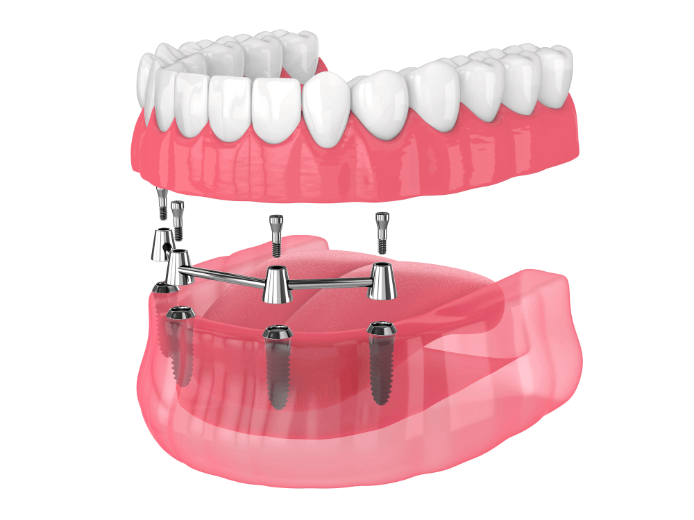 Everything You Need to Know About Dental Implants Before Surgery – Telegraph