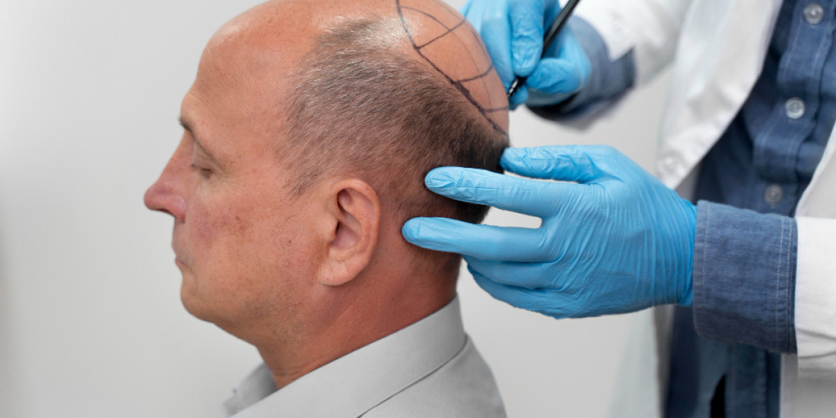 Cost of Hair Transplant in Turkey: What You Need to Know