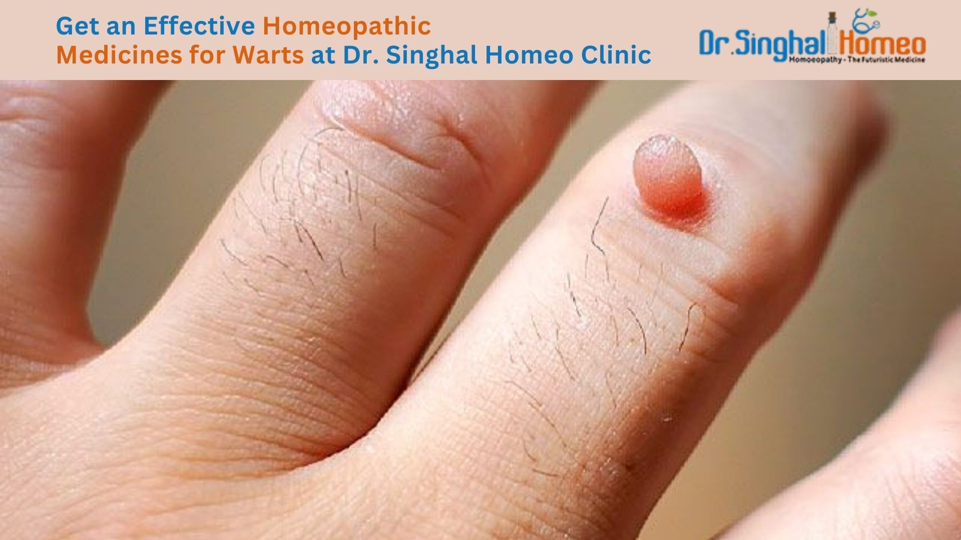 Say Goodbye to Warts with Homeopathic Medications – health