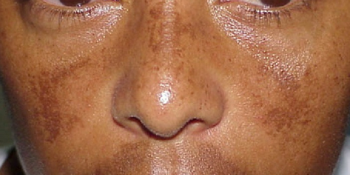 Can Hyperpigmentation Clear on Its Own?
