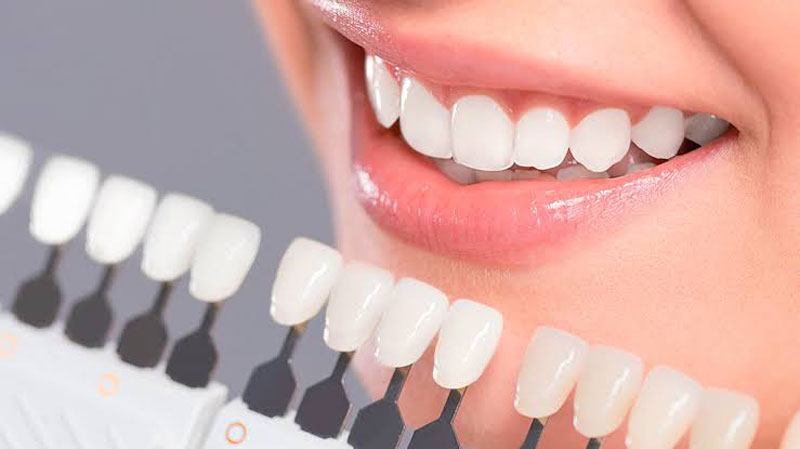Get the porcelain dental veneers to bring your beautiful smile