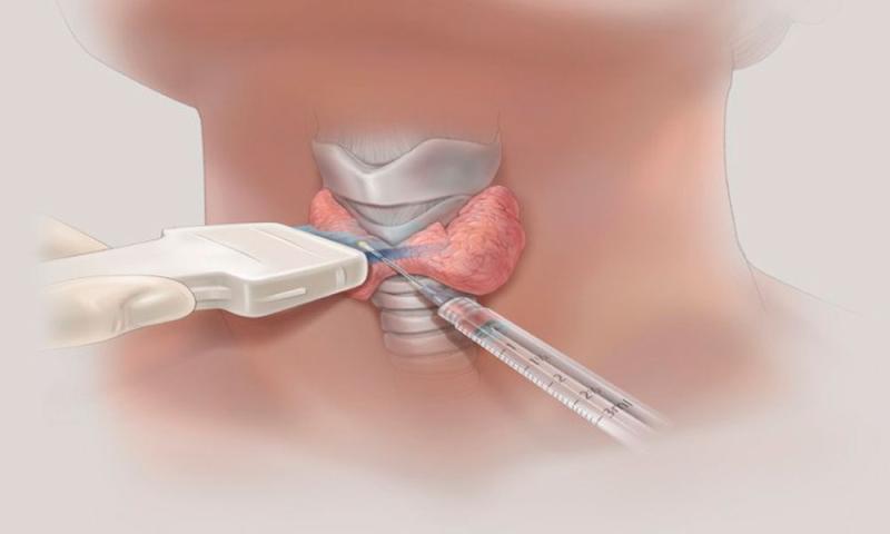 Thyroid Ablation Devices Market Will Reach US$ 1.34 Billion