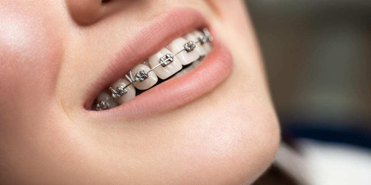 Can I Eat Pizza with Braces?