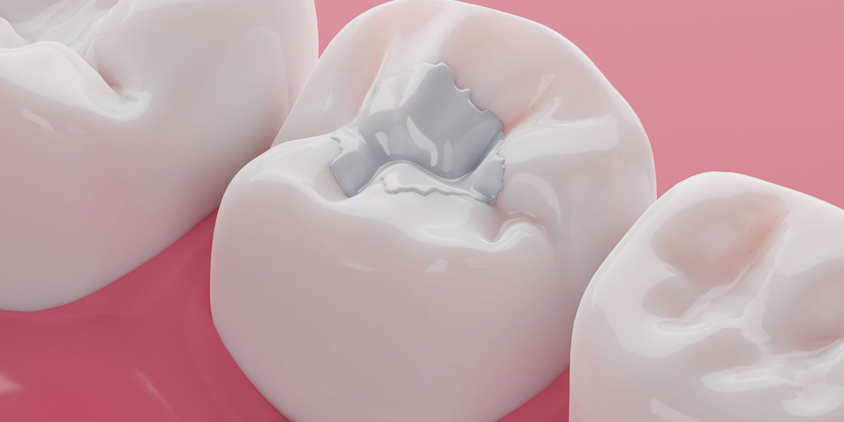 What Foods to Avoid with Fillings?