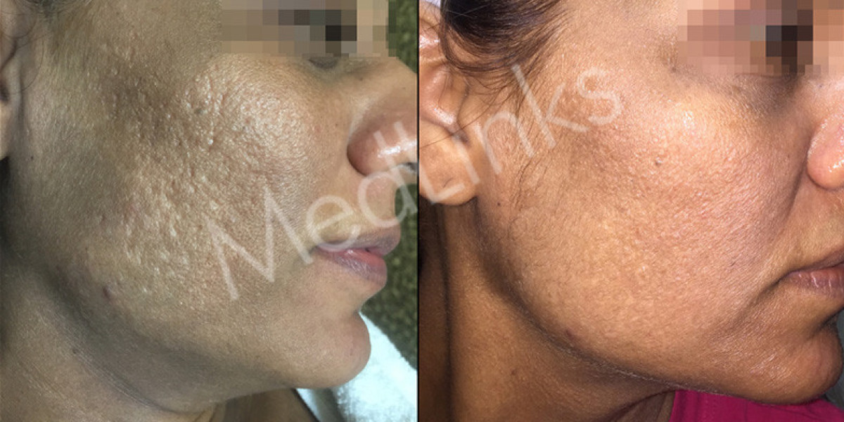 Say Goodbye to Uneven Skin Tone with Expert Pigmentation Treatment in Delhi at Medlinks