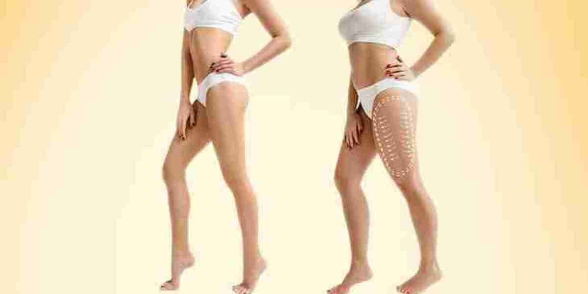 Best Liposuction Treatment in Dubai – Sculpt Your Body with Dr. Hans