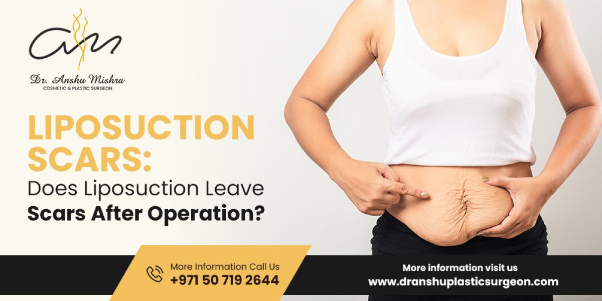Does Liposuction Leave Scars After Operation? Insights from Dubai’s Top Cosmetic Experts