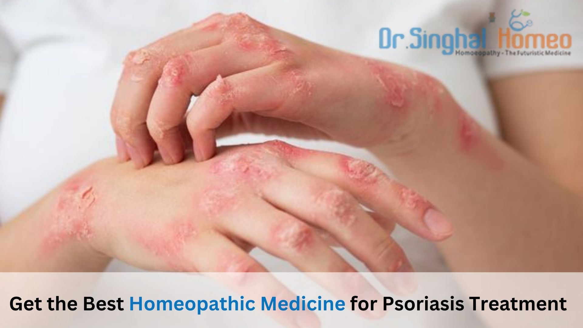 Can Homeopathy Cure Psoriasis? Discover Natural Medications – health