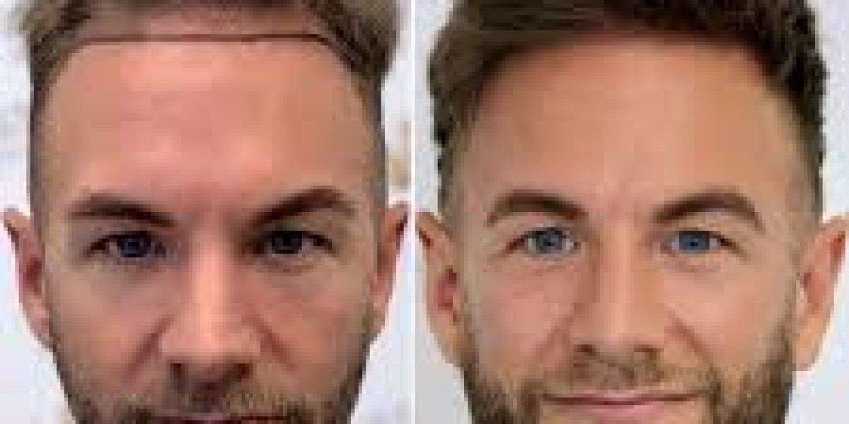 Discover the Best Hair Transplant in London: Your Guide to Natural-Looking Results