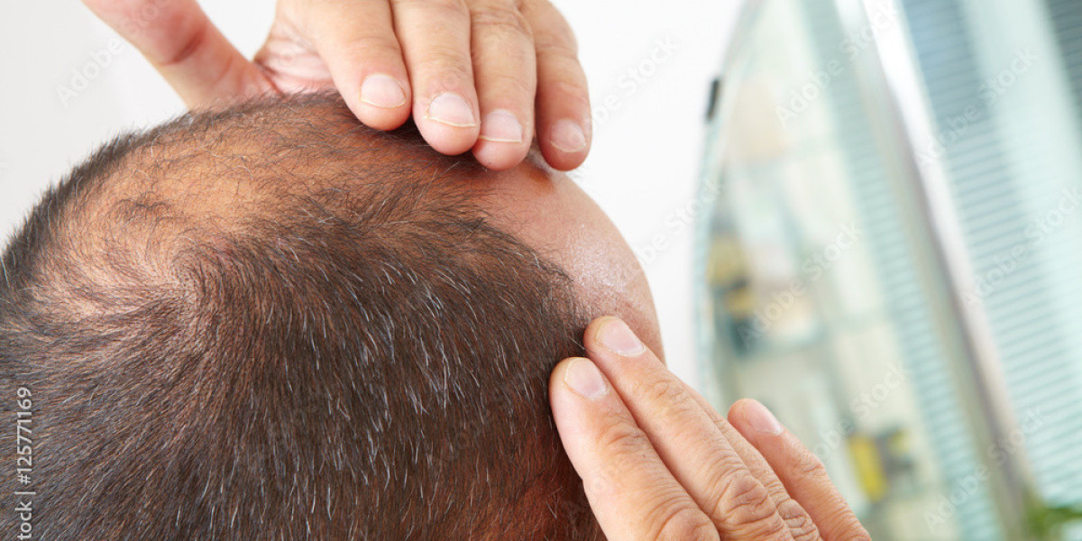 What can a dermatologist do for hair loss?
