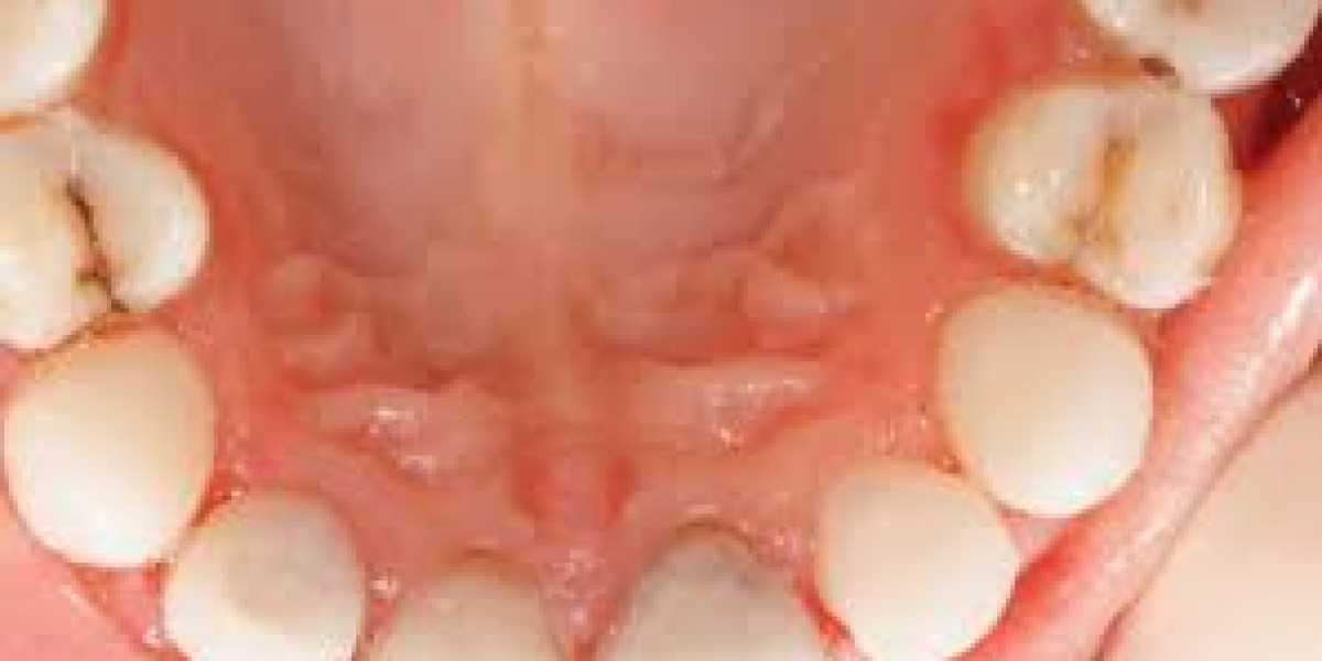 Global Oral Transmucosal Drugs Market Size, Share, Forecast 2023 – 2033