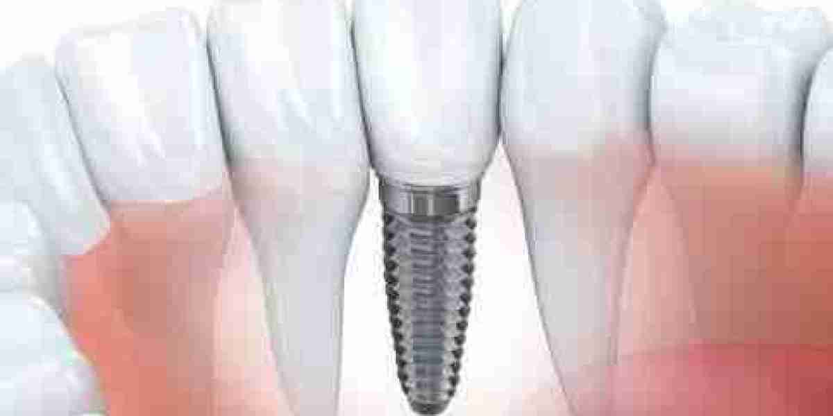 Dental Bone Graft Substitute Market: Reshaping the Future of Oral Regeneration