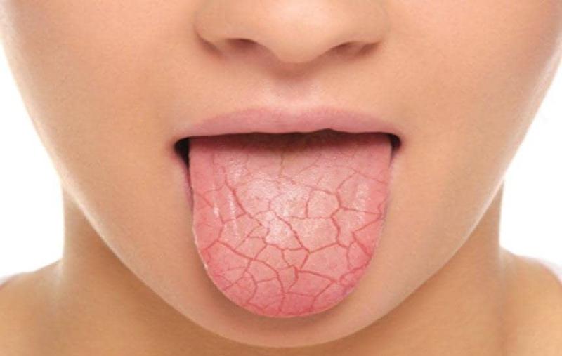 Xerostomia Therapeutics Market Is Projected To Reach Around USD