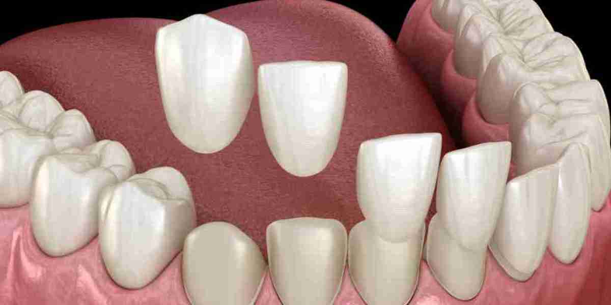 Do Veneers Fall Out with Age?
