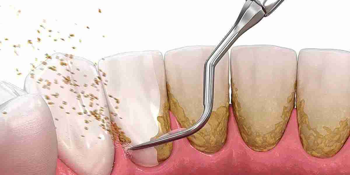 When is Dental Deep Cleaning Necessary?