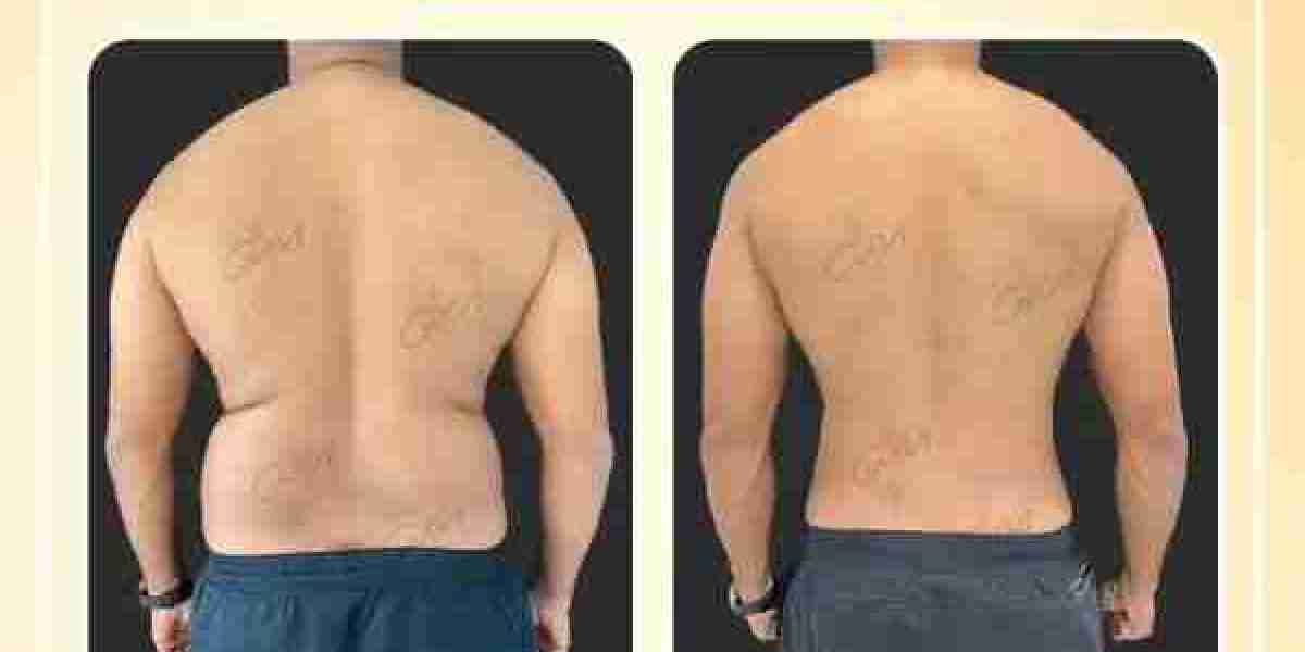 Achieve Your Dream Body with Liposuction in Dubai by Dr. Hans