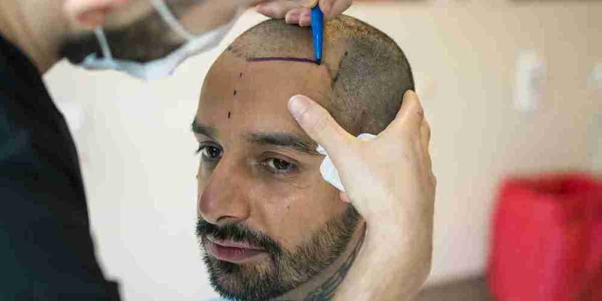 How to hide a hair transplant?
