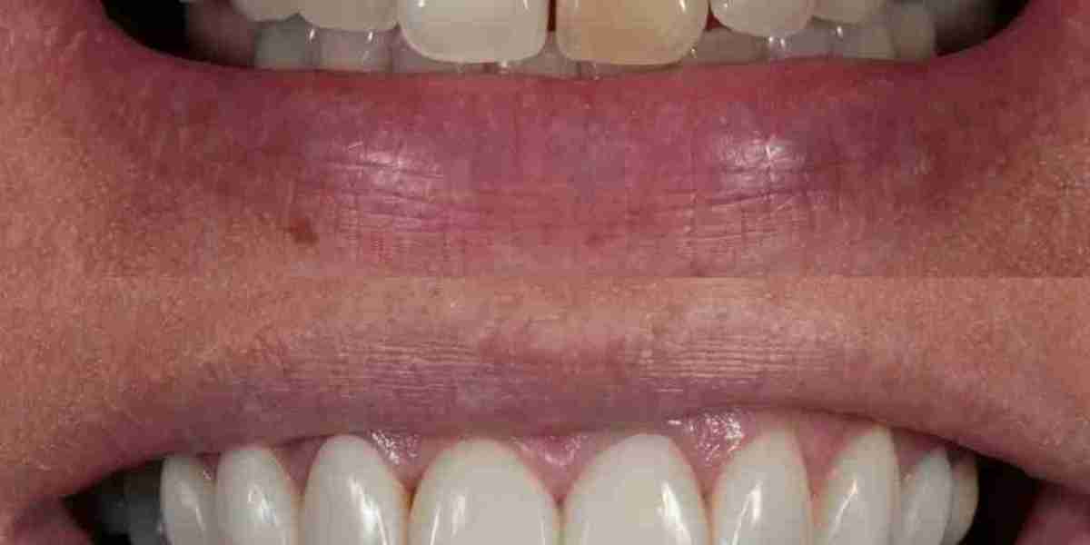 Why has my composite bonding turned yellow?