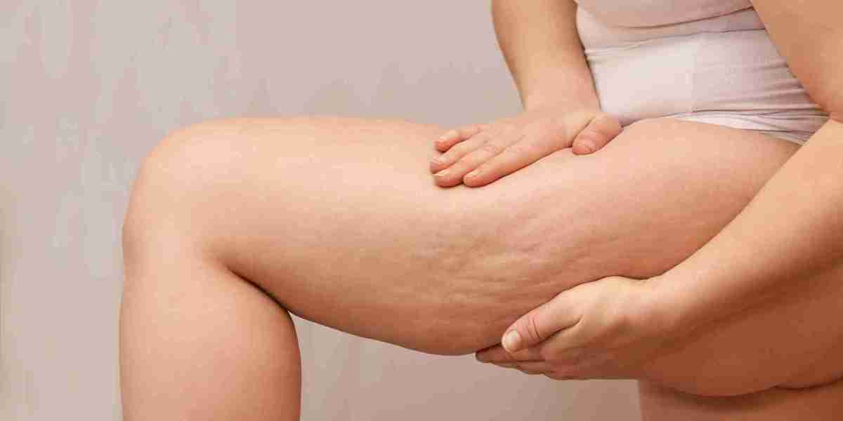 What is the biggest cause of cellulite?