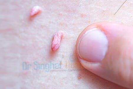 Effective Homeopathy for Skin Tags Treatment