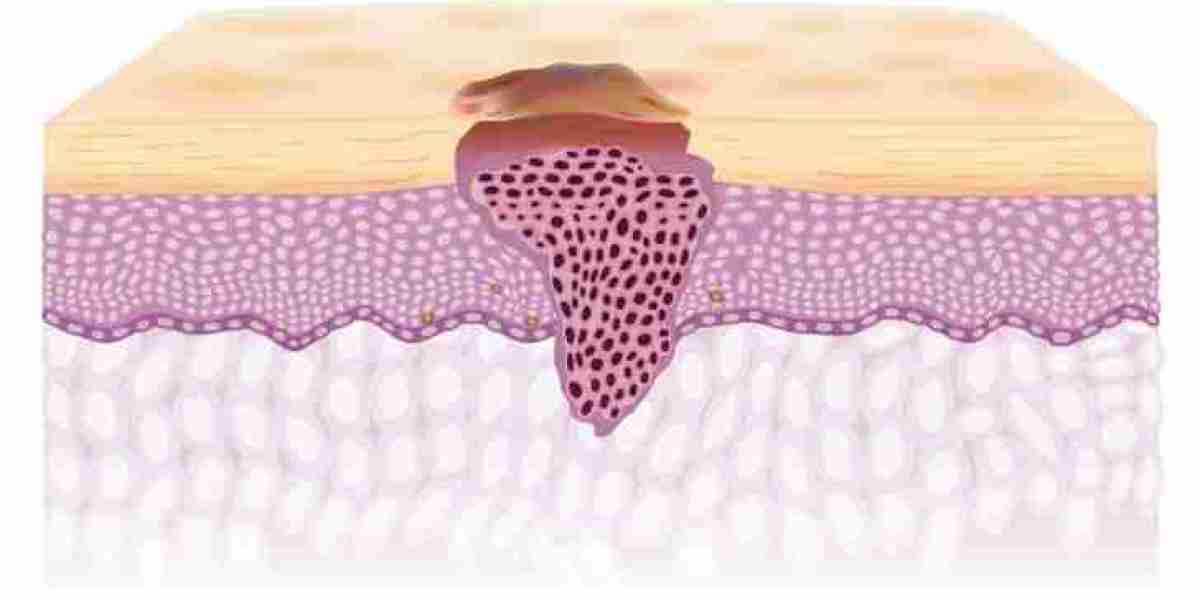 The Sunshine and Shadow: A Market-Oriented Look at the Skin Cancer Market