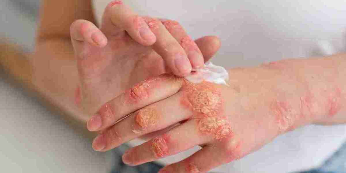 Strategic Insights into the Chronic Pruritus Market Evolution and Therapeutic Advances