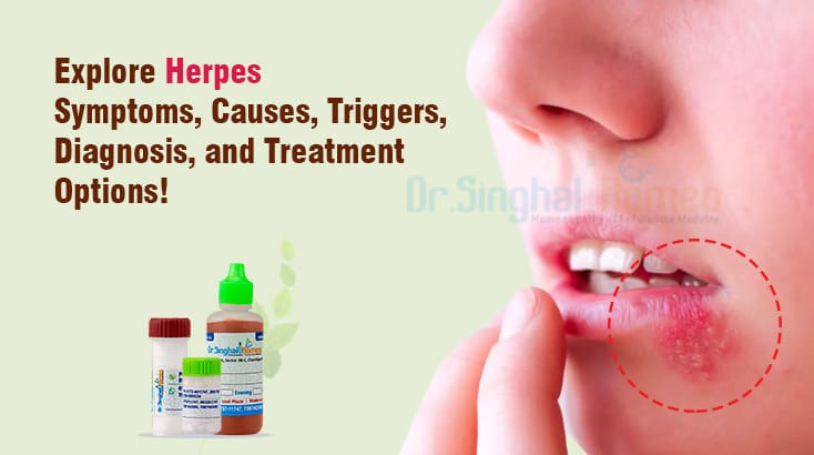 Herpes – Symptoms & Causes | Natural Relief by Dr. Singhal