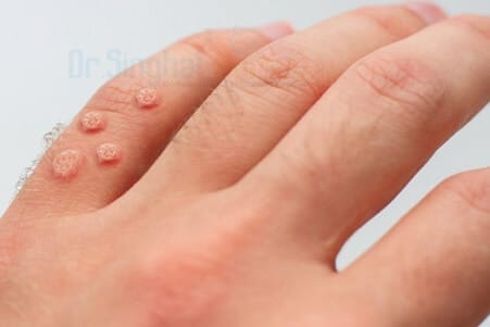 Safe and Effective homeopathic treatment for warts