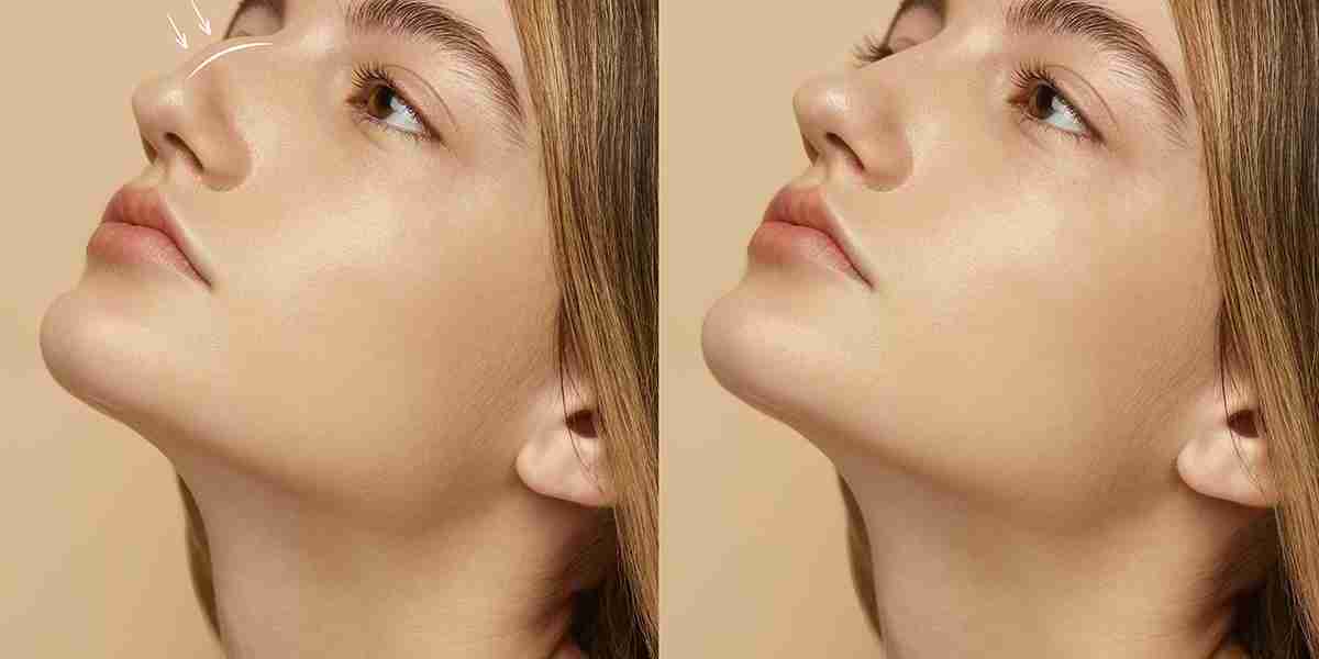 Choosing Between Cosmetic and Functional Rhinoplasty