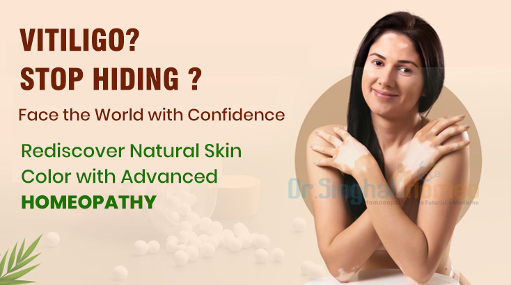 Homeopathic Medicines for Leucoderma & Vitiligo Treatment