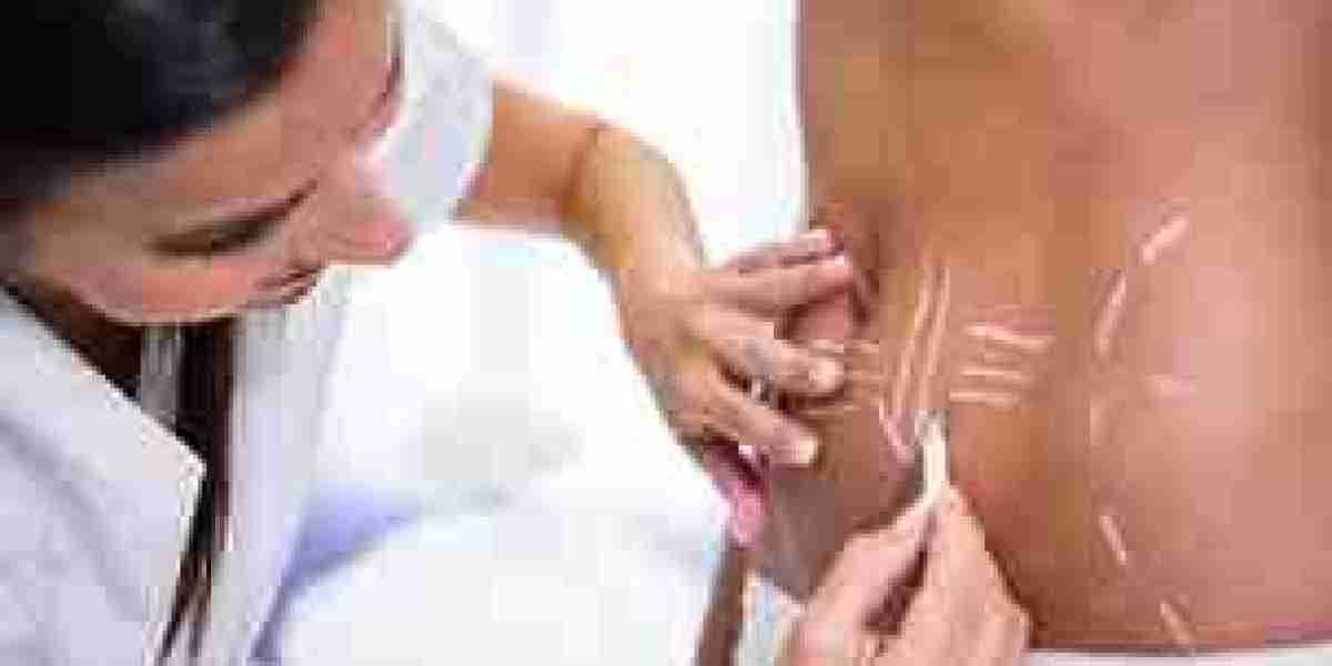 Transform Your Skin with Advanced Solutions for Acne Scars in Hillsboro, Oregon