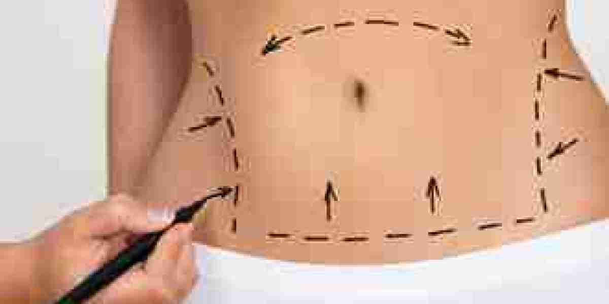 Top Benefits of Liposuction in Islamabad for Long Term Body Shaping