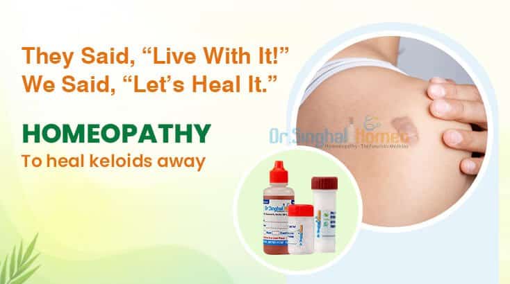 Top 5 Homeopathic Medicines to Treat Keloids