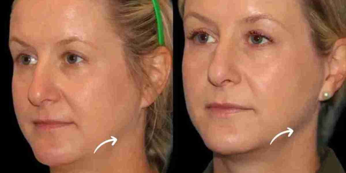 Sculptra Fillers Beauty Lifestyle by Best Doctors in Dubai