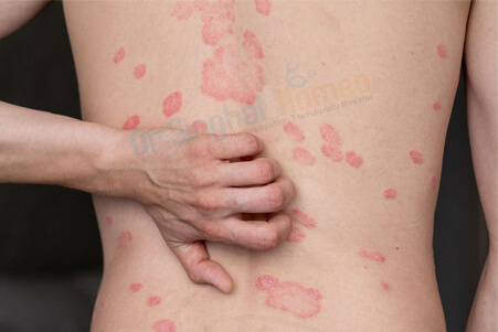 Find the Best Homeopathic Doctor for Psoriasis Treatment