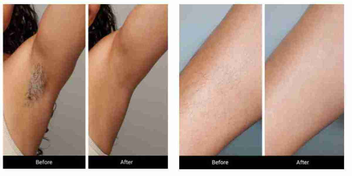 LoweSkin Laser Epilator