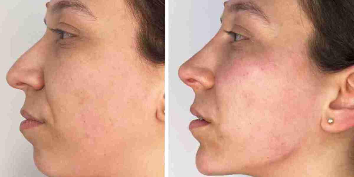 Fat Grafting Face Dubai: What You Should Know Before Paying for It