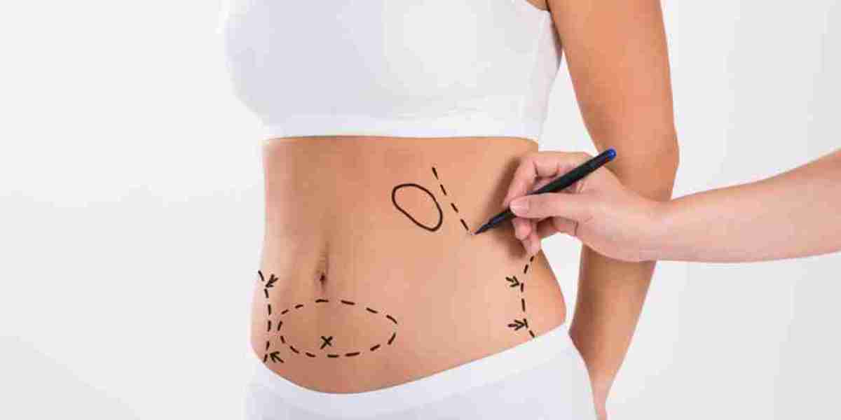 All You Should Know About Liposuction Surgery in Dubai