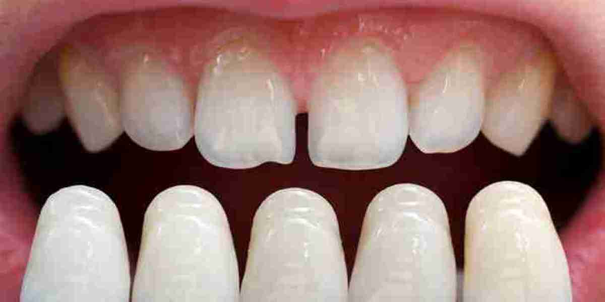 Is Teeth Whitening Newport Beach Worth It? Key Benefits Explained
