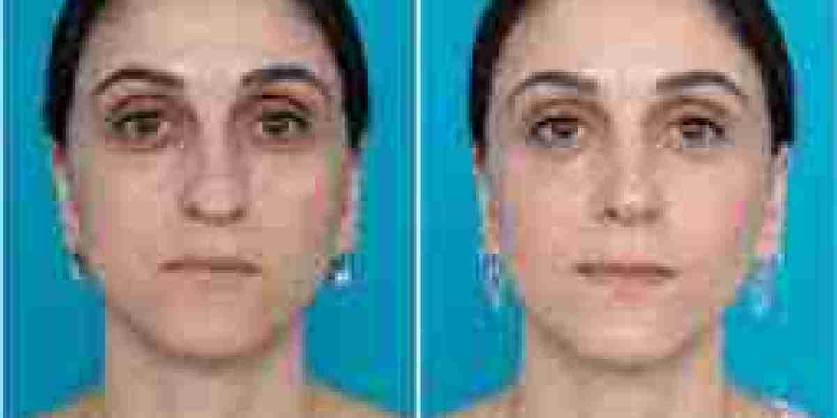 Full Face Fat Transfer Dubai: Restoring Volume Without Looking Overdone