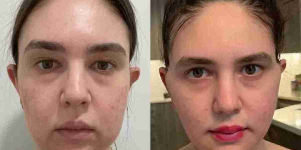Buccal fat removal Surgery in dubai Professional Care
