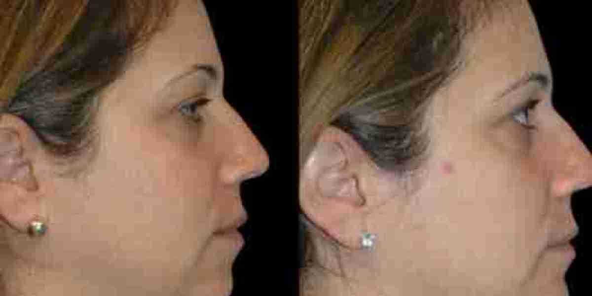 Double chin removal Surgery in dubai Surgical Excellence