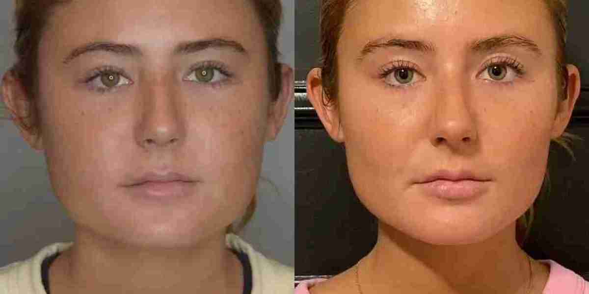 Buccal Fat Removal in Dubai vs Non-Surgical Options