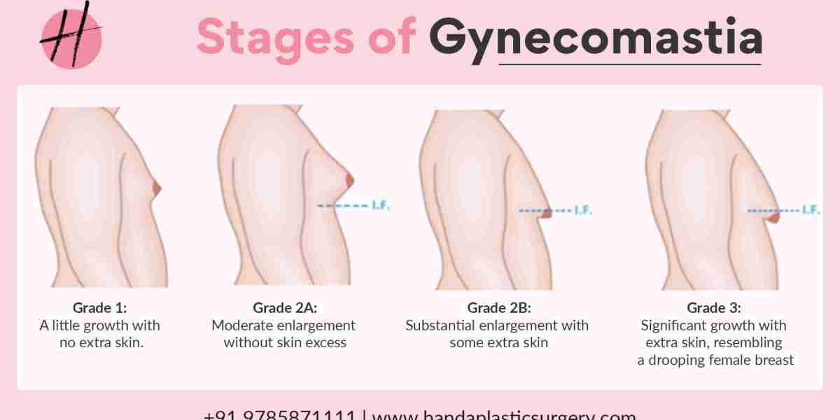 Gynecomastia Surgery in Delhi: Expert Guidance at Handa Plastic Surgery