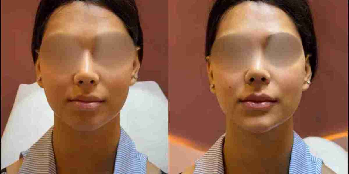Lip Augmentation in Australia: Exploring Treatment Options with Handa Plastic Surgery