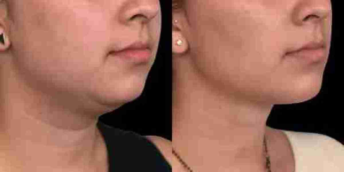 Double chin removal in Dubai Expert Guide